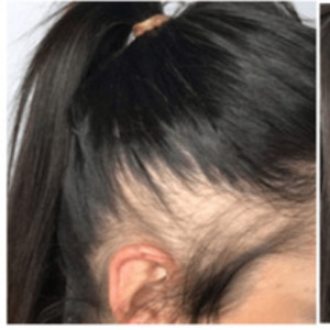 scalpmicropigmentation